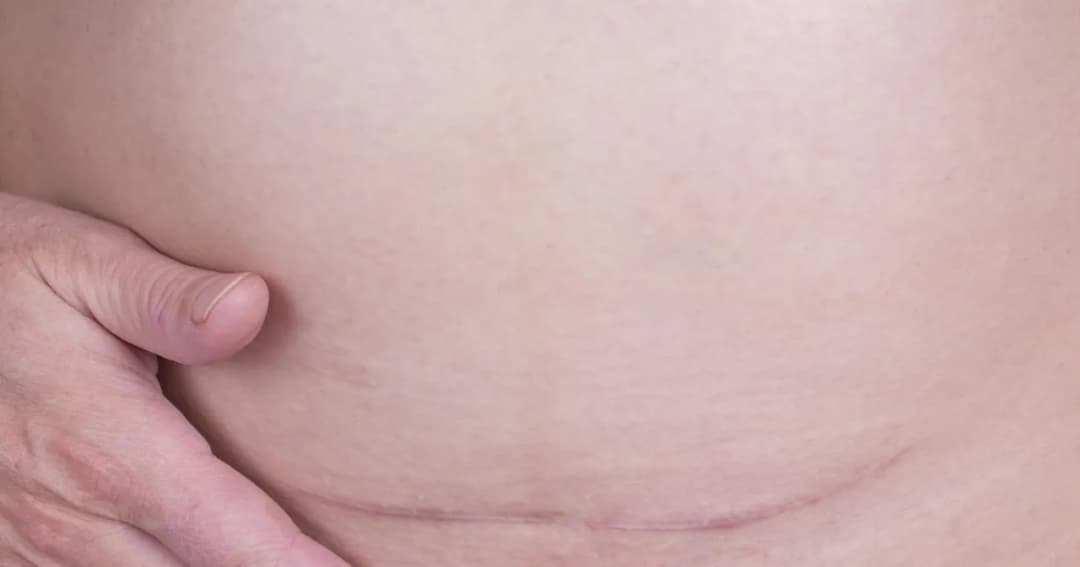 Jakie zioła na zrosty pooperacyjne są najskuteczniejsze?