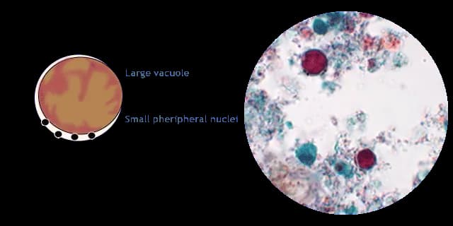 Blastocystis hominis: Jak rozpoznać i skutecznie leczyć?