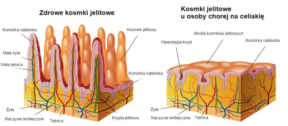 Zanik kosmków jelitowych: 5 faktów o których musisz wiedzieć