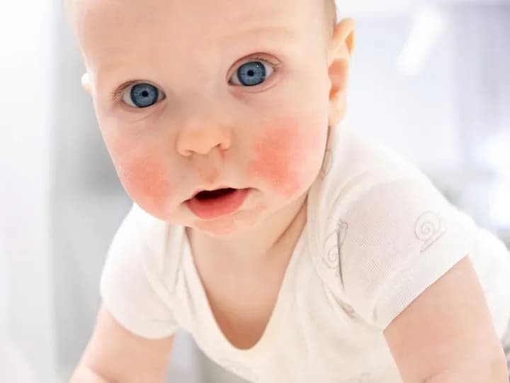 Uczulenia pokarmowe u dzieci: 7 objawów które niepokoją