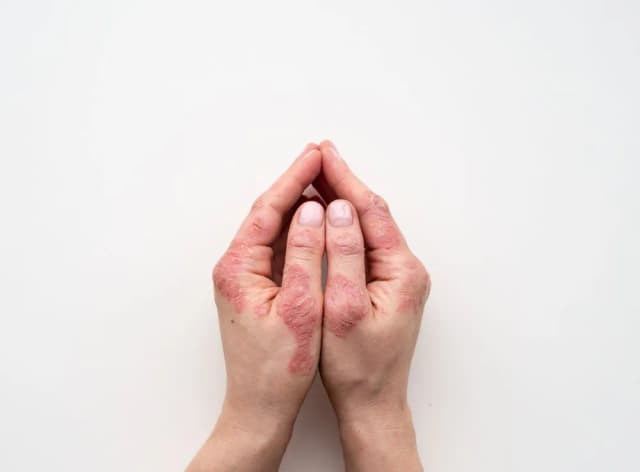 Łuszczyca dłoni: Jak rozpoznać 5 kluczowych objawów?