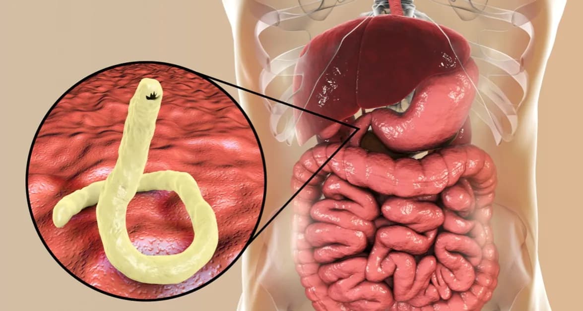 Przywra jelitowa: 5 alarmujących objawów i metody leczenia