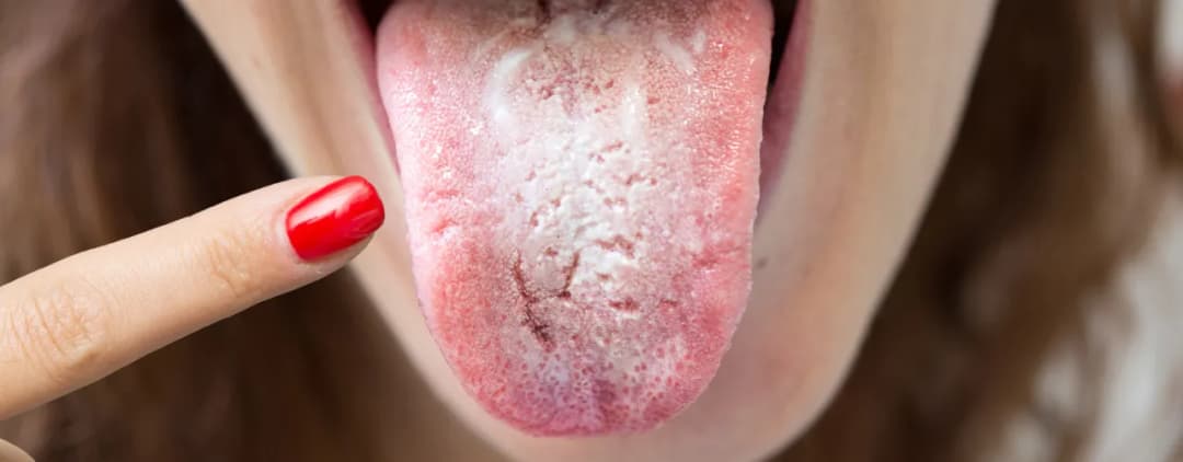 Jak leczyć candidę probiotykami? 5 skutecznych metod