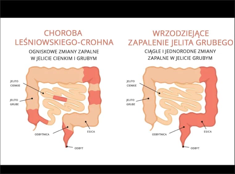 Choroby autoimmunologiczne jelit: 5 głównych przyczyn i terapii